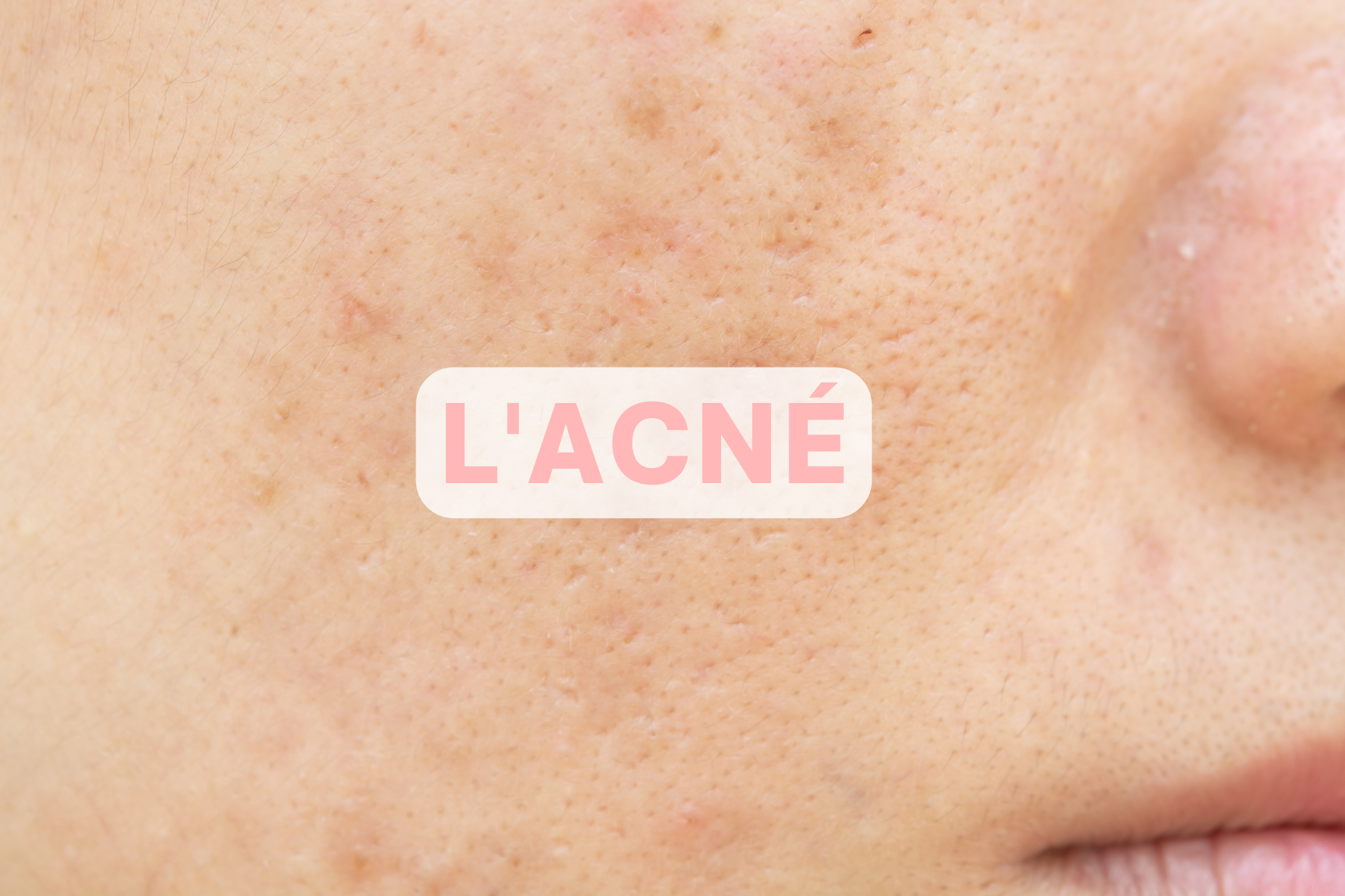 L’acné : causes et conséquences