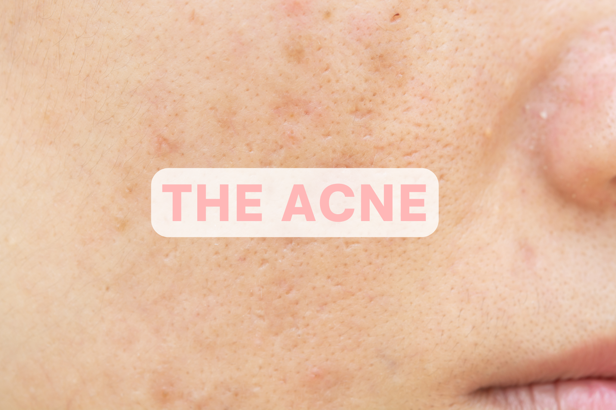 Acne : causes and consequences